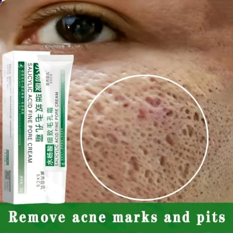 Salicylic Acid Blackhead Remover - Krim Pembersih Pori Asam Salisilat Mengecilkan