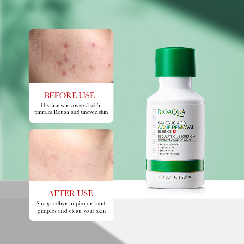 35Ml BIOAOUA Asam Salisilat Es - Salicylic Acid Blackhead Remover ulasan dan harga