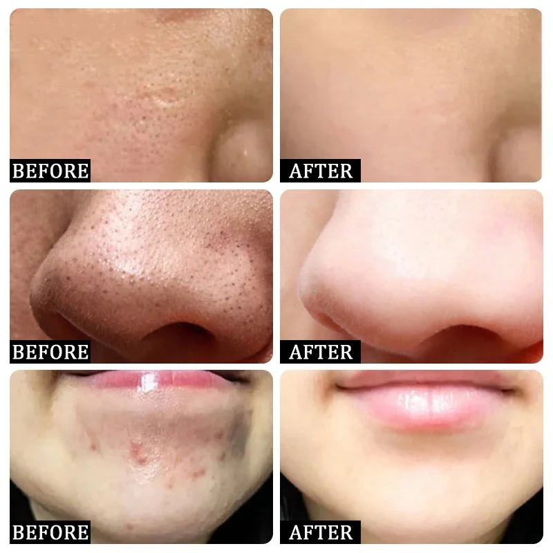 Krim Pembersih Pori Asam Salis - Salicylic Acid Blackhead Remover ulasan dan harga