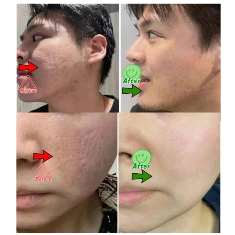 Krim Pembersih Pori Asam Salis - Salicylic Acid Blackhead Remover ulasan dan harga