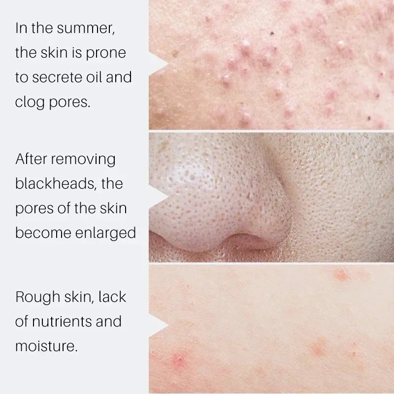 Serum Penyusut Pori-pori Asam  - Salicylic Acid Blackhead Remover ulasan dan harga