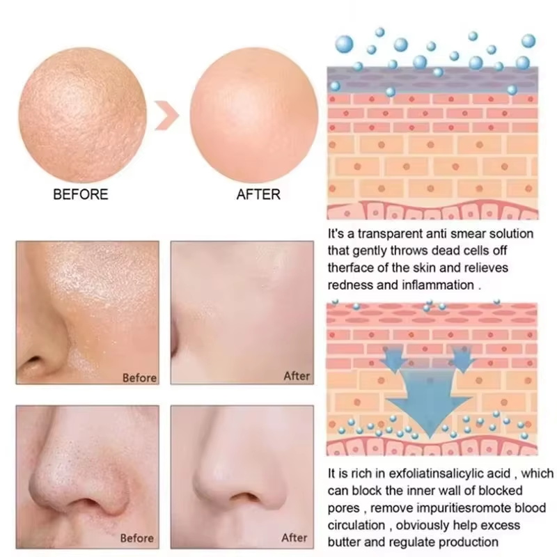 Serum Penyusut Pori-pori Asam  - Salicylic Acid Blackhead Remover ulasan dan harga